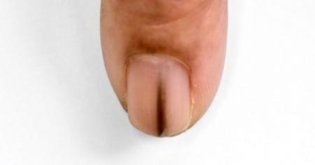 Run-for-your-life-and-visit-a-doctor,-if-this-appears-on-your-nail-on-HWN-CANCER
