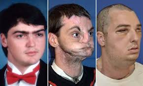 Transplanted-faces-and-changes-that-occurs-over-time-on-HWN-INSIGHTS