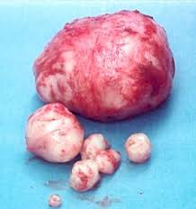 Fibroid-discussions-on-HWN-FAN-COLUMN