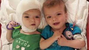 Separated-Conjoined-Twins-(Jadon-and-Anias-McDonald)-Released-on-HWN-FLASH