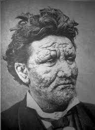 17-New-Leprosy-Cases-Detected-In-Nigeria-on-HWN-LEPROSY